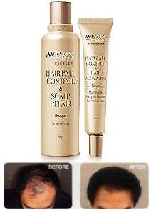  Avelon Halt Hair Loss & Promote Hair Re-Growth (Авелон Стой Облысение Волосы Содействие & Re-Growth)