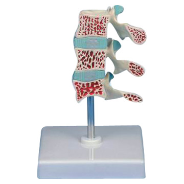  Advanced Osteoporosis Model (Erweiterte Osteoporose-Modell)